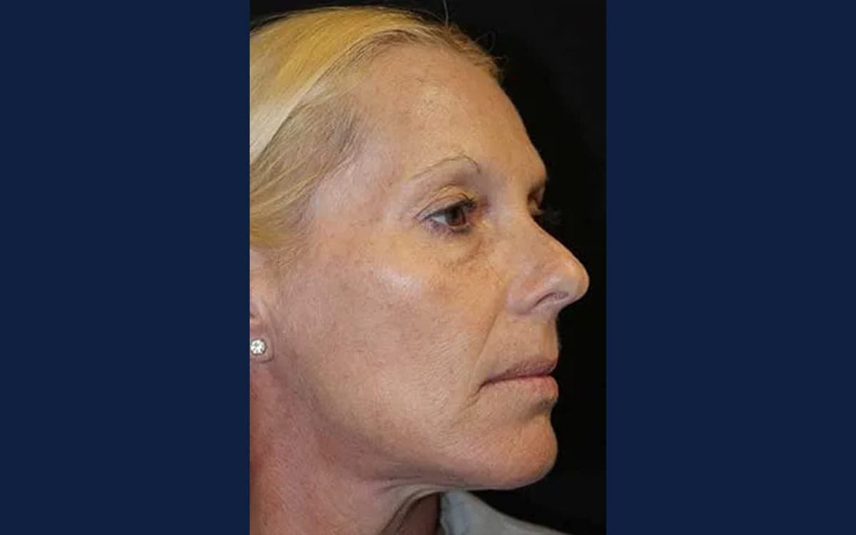 After treatment