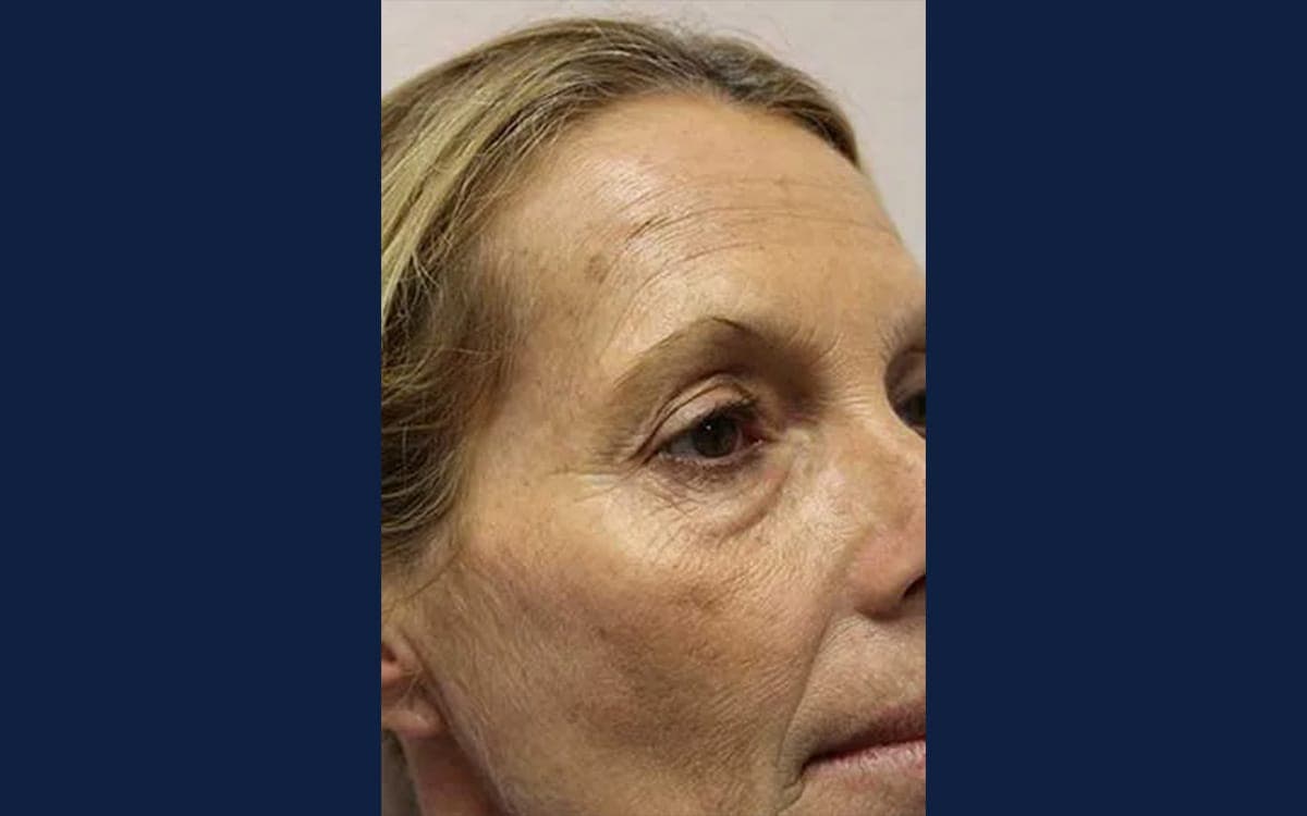 Before treatment