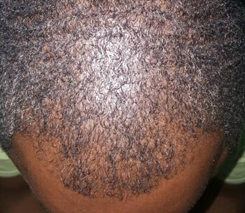PRP 1 - After Treatment