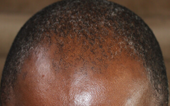 PRP 1 - Before Treatment