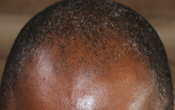 PRP Hair Restoration Before-4