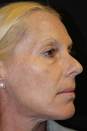 Botox Results