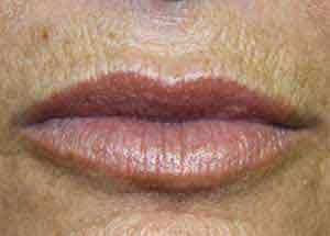 Juvederm Lip Treatment Results