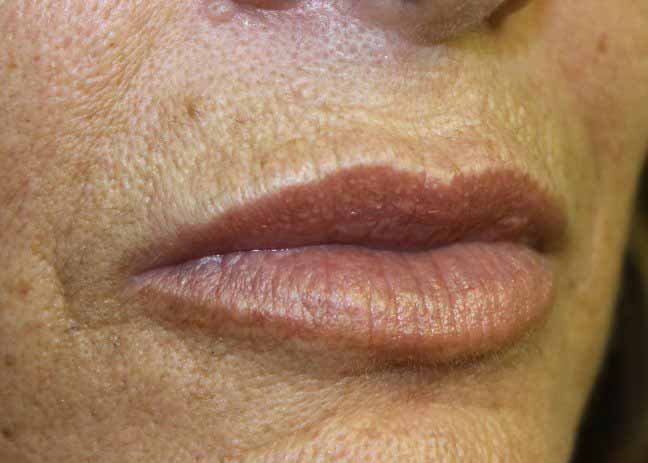 Juvederm Lip Treatment Results