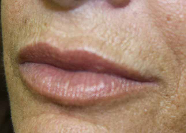 Juvederm Lip Treatment Results