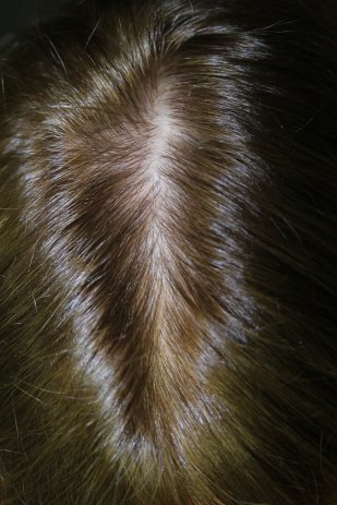 PRP Hair Restoration After-3