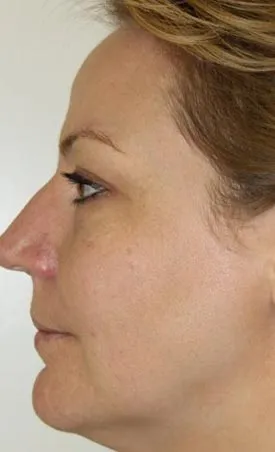 Vampire Facial After