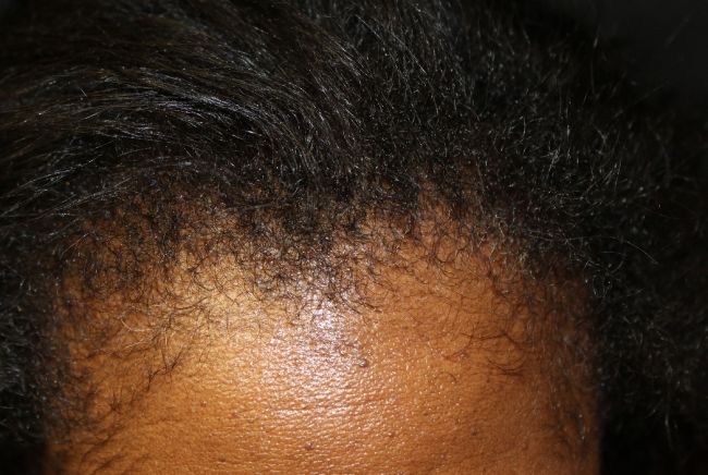 PRP Hair Restoration After-2