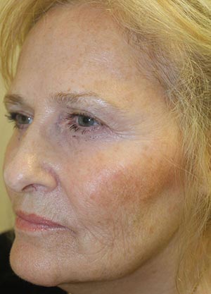 Vampire Facelift 1 - After Treatment