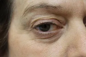Vampire Facelift Before