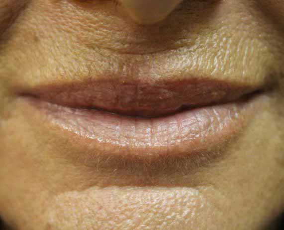 Juvederm Lip Treatment Results