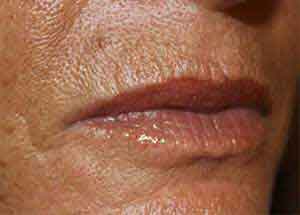 Juvederm Lip Treatment Results