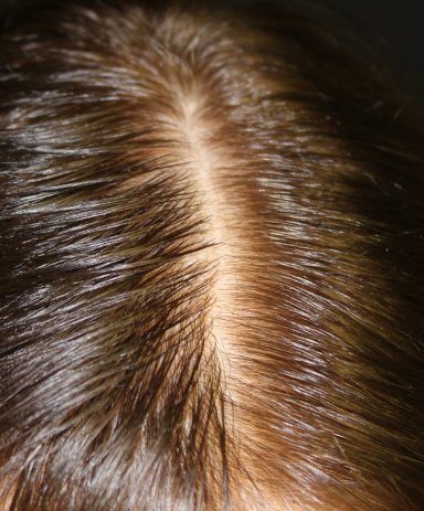 PRP Hair Restoration Before-3