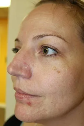 Vampire Facial Before