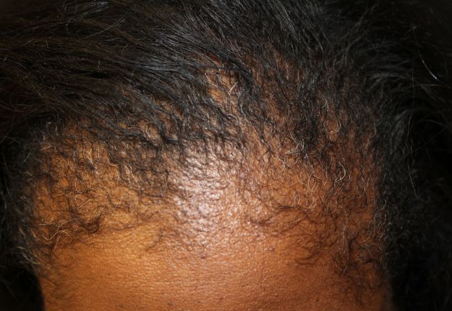 PRP Hair Restoration Before-2