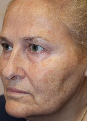 Vampire Facelift 1 - Before Treatment