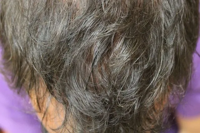 PRP Hair Restoration After