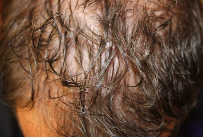 PRP Hair Restoration Before