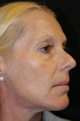 Botox 1 - After Treatment