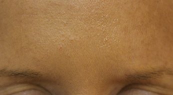 Botox 2 - After Treatment