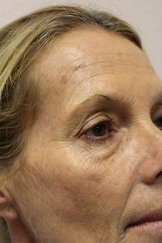 Botox 1 - Before Treatment