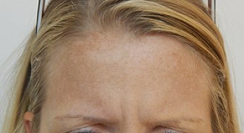 Botox 2 - Before Treatment