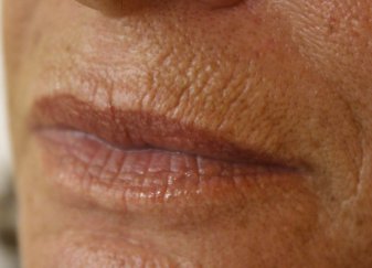Lip Augmentation 2 - Before Treatment