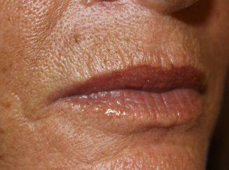 Lip Augmentation 3 - Before Treatment