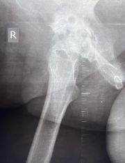 Right Hip Arthritis 1 - Before Treatment