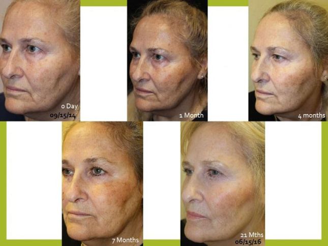 Before and After Vampire Facelift