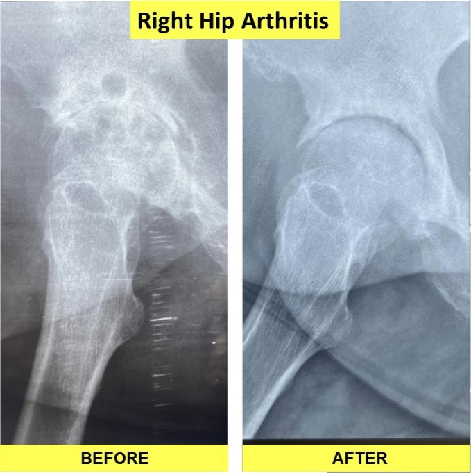 Before and After X-ray of Right Hip Arthritis